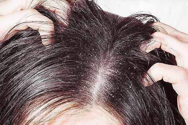 Anti-Dandruff Shampoos